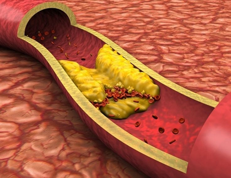 Hyperlipidemia, High Cholesterol: Levels, Causes, Symptoms and Diagnosis